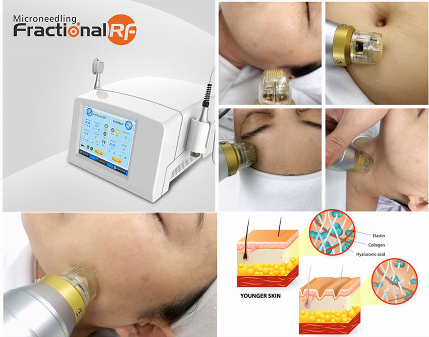 Przenośna maszyna mikroigłowa frakcyjna Rf do redukcji zmarszczek na szyi